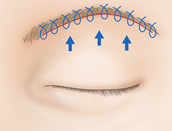眉毛下切開法（眉下リフト）の施術プロセス その3
