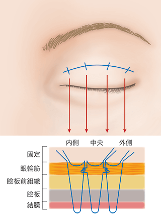 3 places connecting clasp