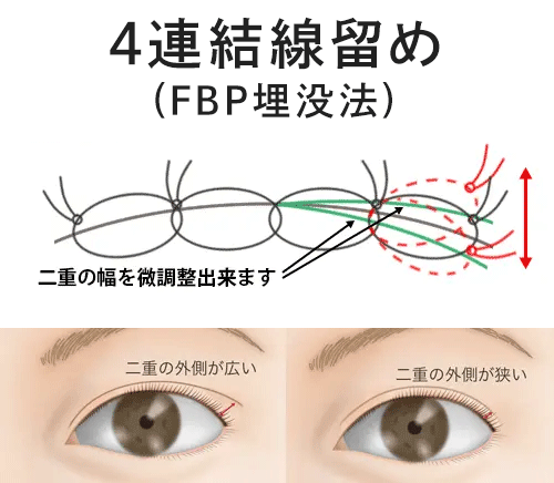 埋没法 4連結線留め法