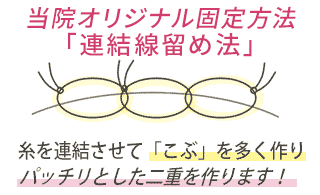 フォーエバーブリリアント埋没法 当院オリジナルの「連結線留め法」