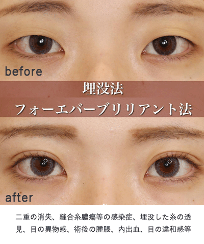 フォーエバーブリリアント埋没法症例