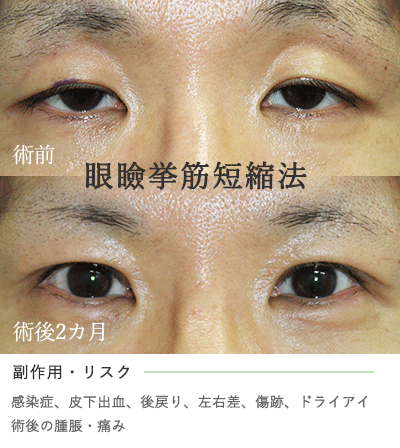眼瞼下垂の手術 眼瞼挙筋短縮法とは