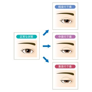 眼瞼挙筋短縮法（眼瞼下垂の手術）とは