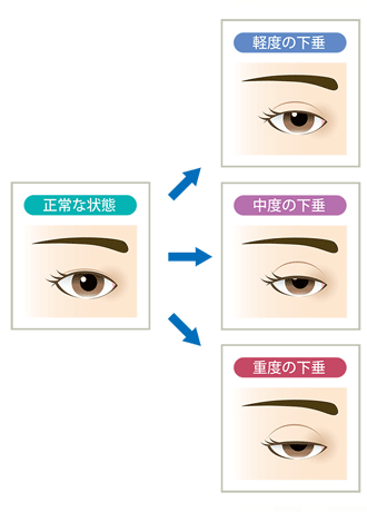 眼瞼下垂とは