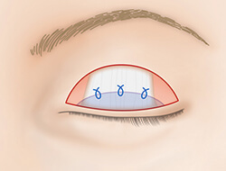 眼瞼挙筋短縮法（眼瞼下垂の手術）の施術プロセス その2