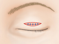 眼瞼挙筋短縮法（眼瞼下垂の手術）の施術プロセス その3