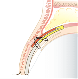 ミューラー筋タッキング法（MT法）-切らない眼瞼下垂の手術-の施術プロセス その1