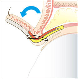 ミューラー筋タッキング法（MT法）-切らない眼瞼下垂の手術-の施術プロセス その2