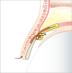 ミューラー筋タッキング法（MT法）-切らない眼瞼下垂の手術-の施術プロセス その3