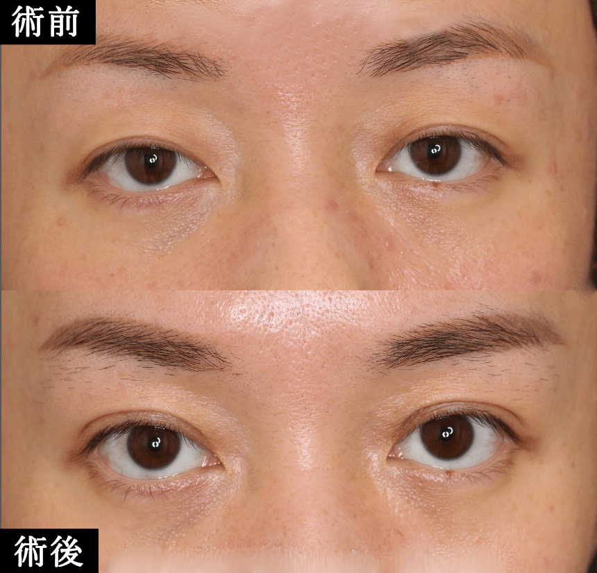 切らない眼瞼下垂治療 MT法　症例写真6