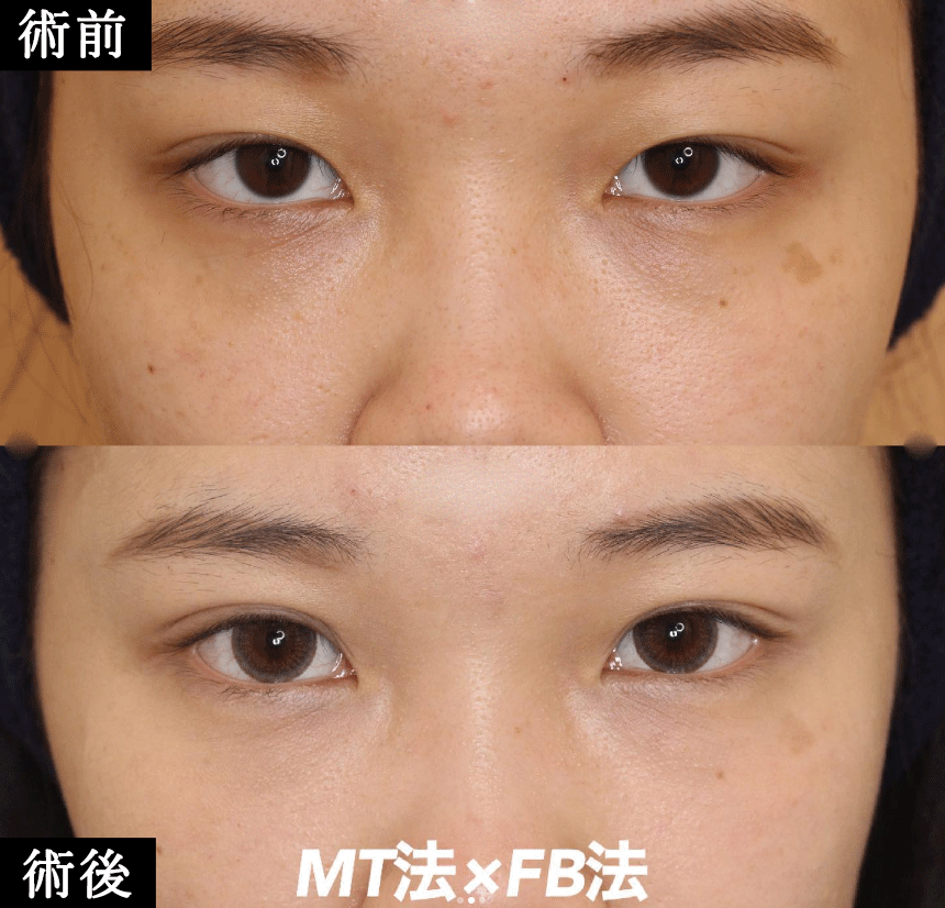 切らない眼瞼下垂治療 MT法　症例写真9