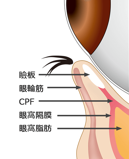 たれ目形成の施術方法