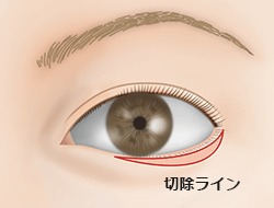 たれ目形成の施術プロセス その6