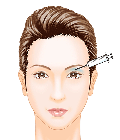 ヒアルロン酸注入で目の上のくぼみを解消