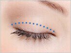 眼瞼挙筋短縮法（眼瞼下垂の手術）