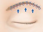 眉毛下切開法（眉下リフト）