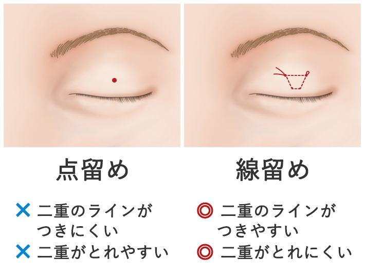 線留とは