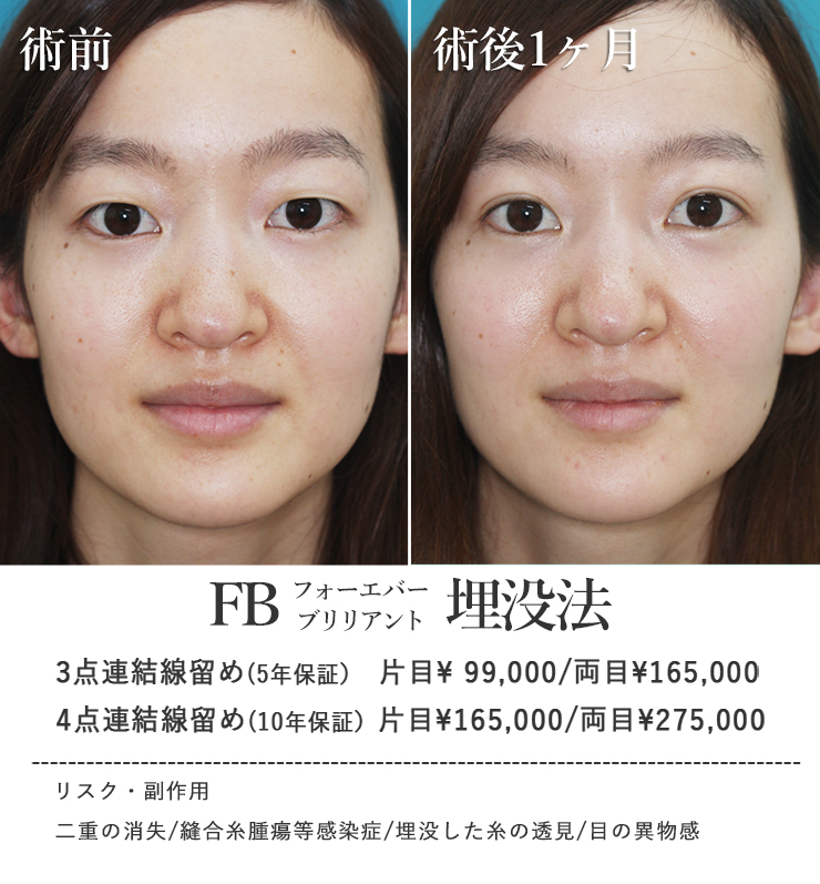 二重埋没法症例