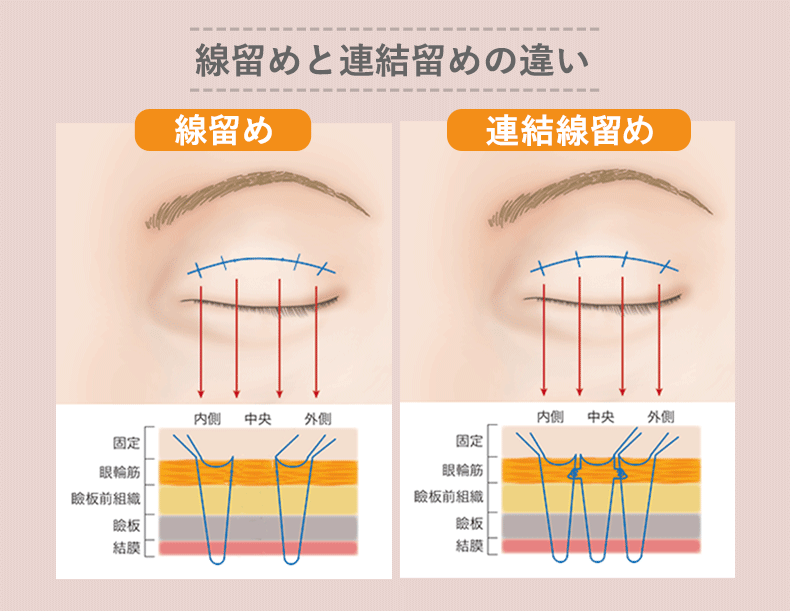 線留めと連結留め