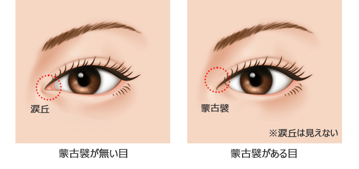 蒙古襞形成（目頭切開修正）とは