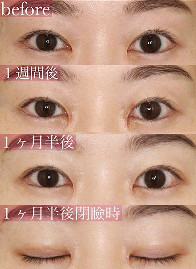 蒙古襞形成（目頭切開修正）