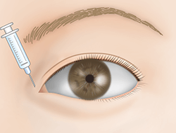 たれ目形成下眼瞼皮弁法の施術プロセス その2