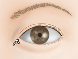 たれ目形成VY法の施術プロセス その4