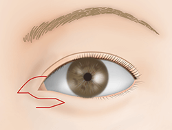 たれ目形成下眼瞼皮弁法の施術プロセス その3