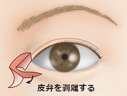たれ目形成下眼瞼皮弁法の施術プロセス その5