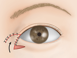 たれ目形成下眼瞼皮弁法の施術プロセス その6