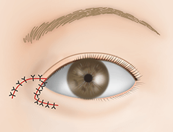 たれ目形成下眼瞼皮弁法の施術プロセス その7