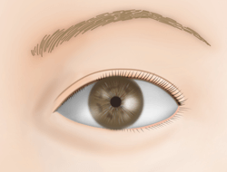 たれ目形成下眼瞼皮弁法の施術プロセス その8