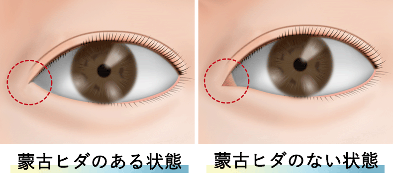 目頭切開　蒙古襞がある状態　蒙古襞がない状態