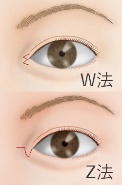 目頭切開法の施術プロセス 切開