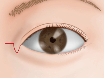 目頭切開Z法