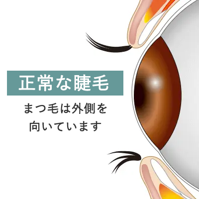 逆さまつ毛とは