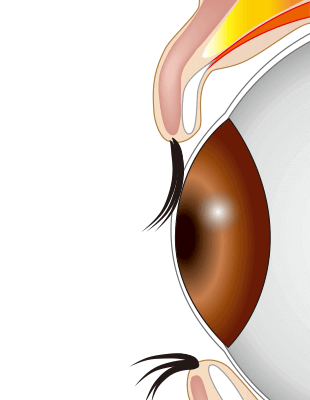 眼瞼内反