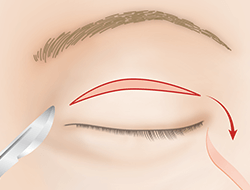 逆さまつ毛手術・治療のプロセス 切開法 上まぶた・正面2