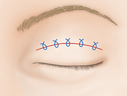逆さまつ毛手術・治療のプロセス 切開法 上まぶた・正面3