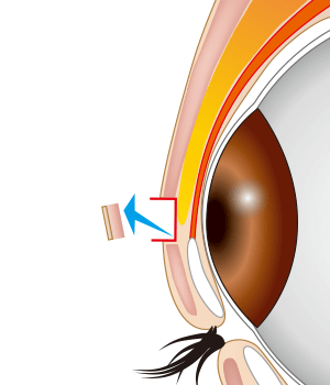 逆さまつ毛治療　切開法
