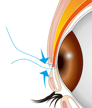 逆さまつ毛手術・治療のプロセス 切開法 上まぶた・横向き3