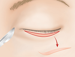 逆さまつ毛手術・治療のプロセス 切開法 下まぶた・正面2