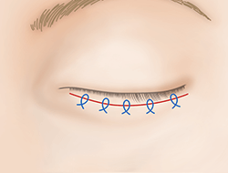 逆さまつ毛手術・治療のプロセス 切開法 下まぶた・正面3