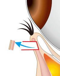 逆さまつ毛手術・治療のプロセス 下まぶた切開法