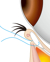 逆さまつ毛手術・治療のプロセス 切開法 下まぶた・横向き3