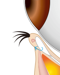 逆さまつ毛手術・治療のプロセス 切開法 下まぶた・横向き4
