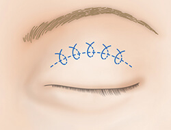 上まぶたたるみ取り（切開法）の施術プロセス 施術
