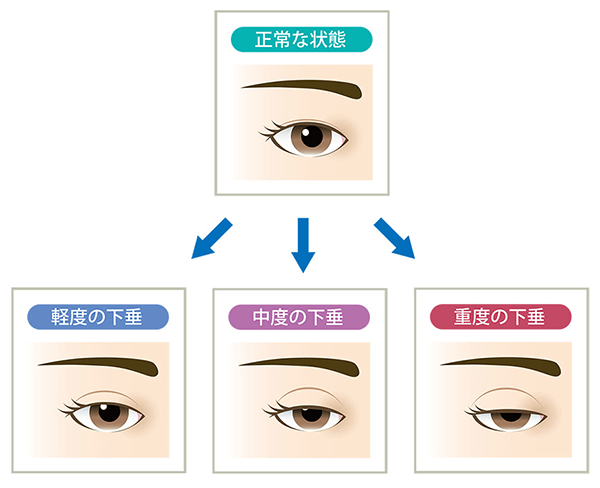 眠たそうな目 眼瞼下垂 の悩みやご相談 二重整形施術なら大塚美容形成外科 歯科