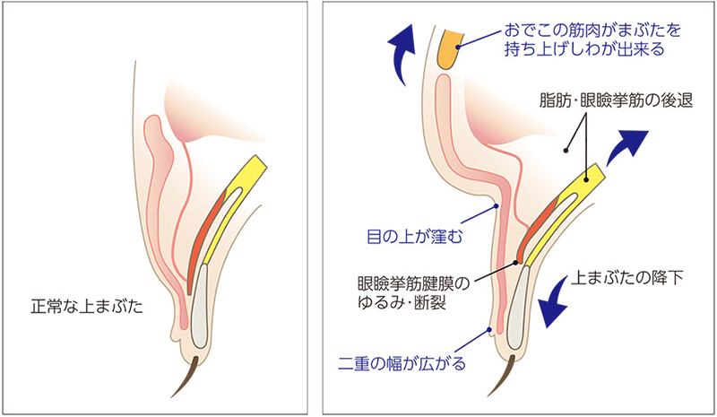 眼瞼下垂の症状