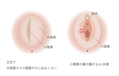 小陰唇の正常の大きさは？